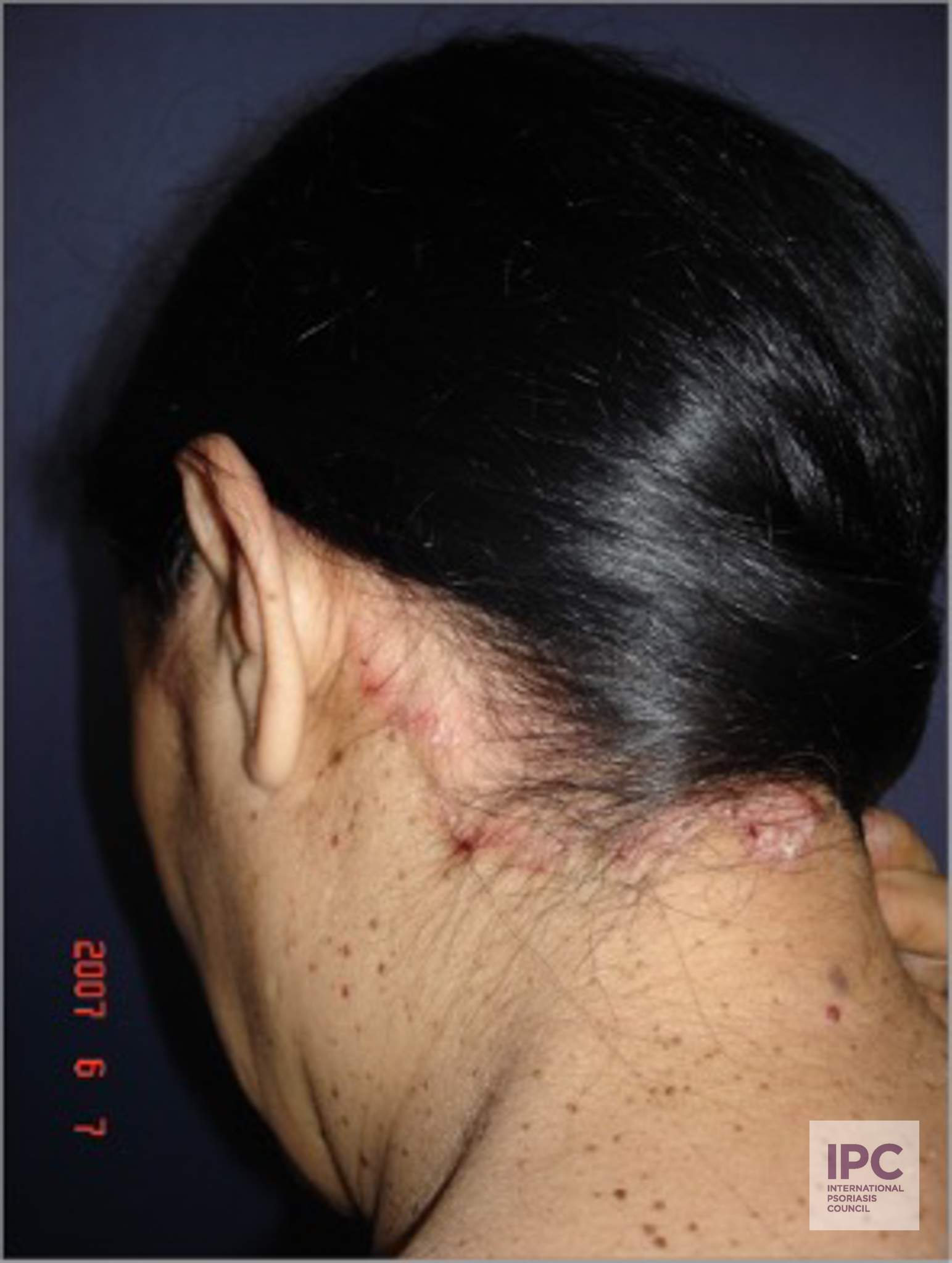 Plaque psoriasis