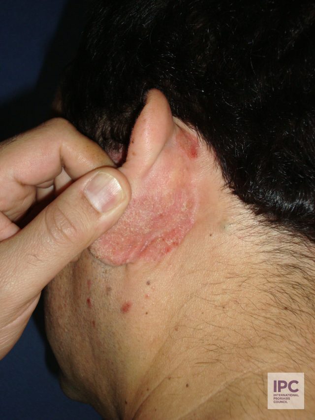 Plaque psoriasis