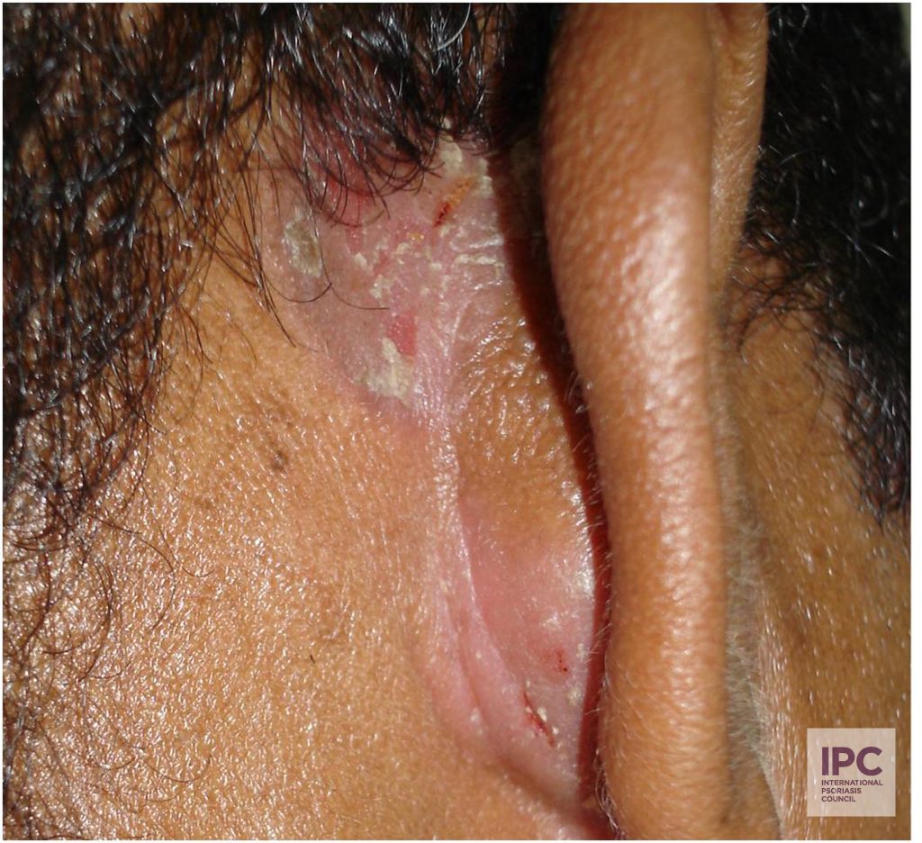 Plaque psoriasis