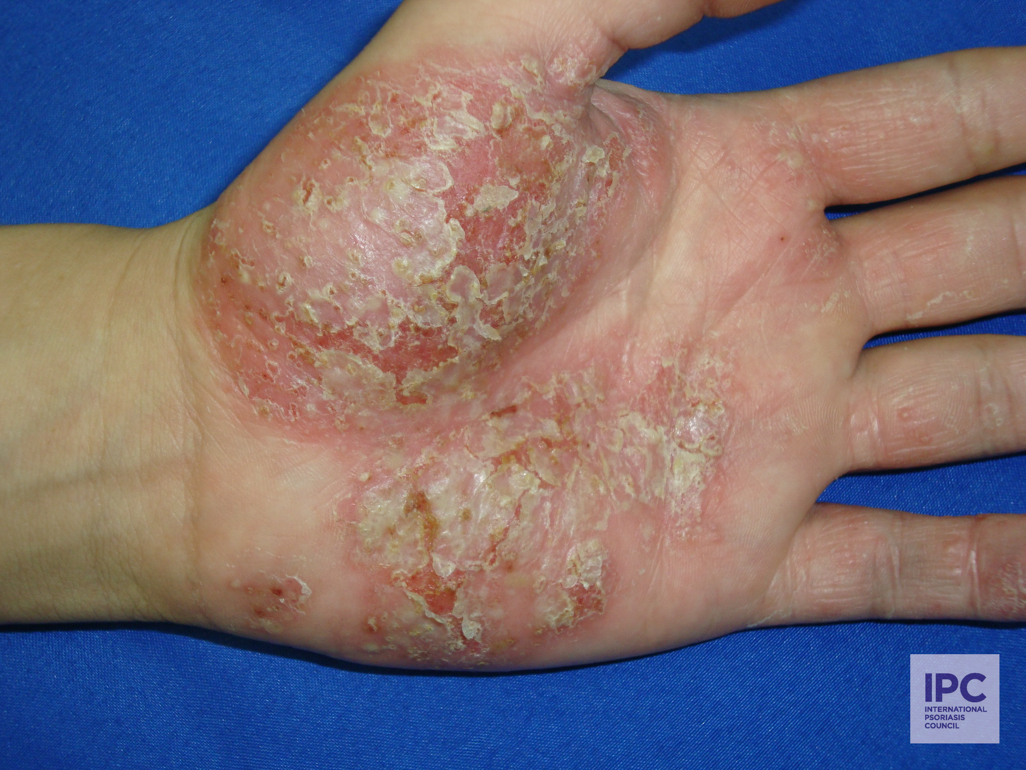 Palmoplantar psoriasis