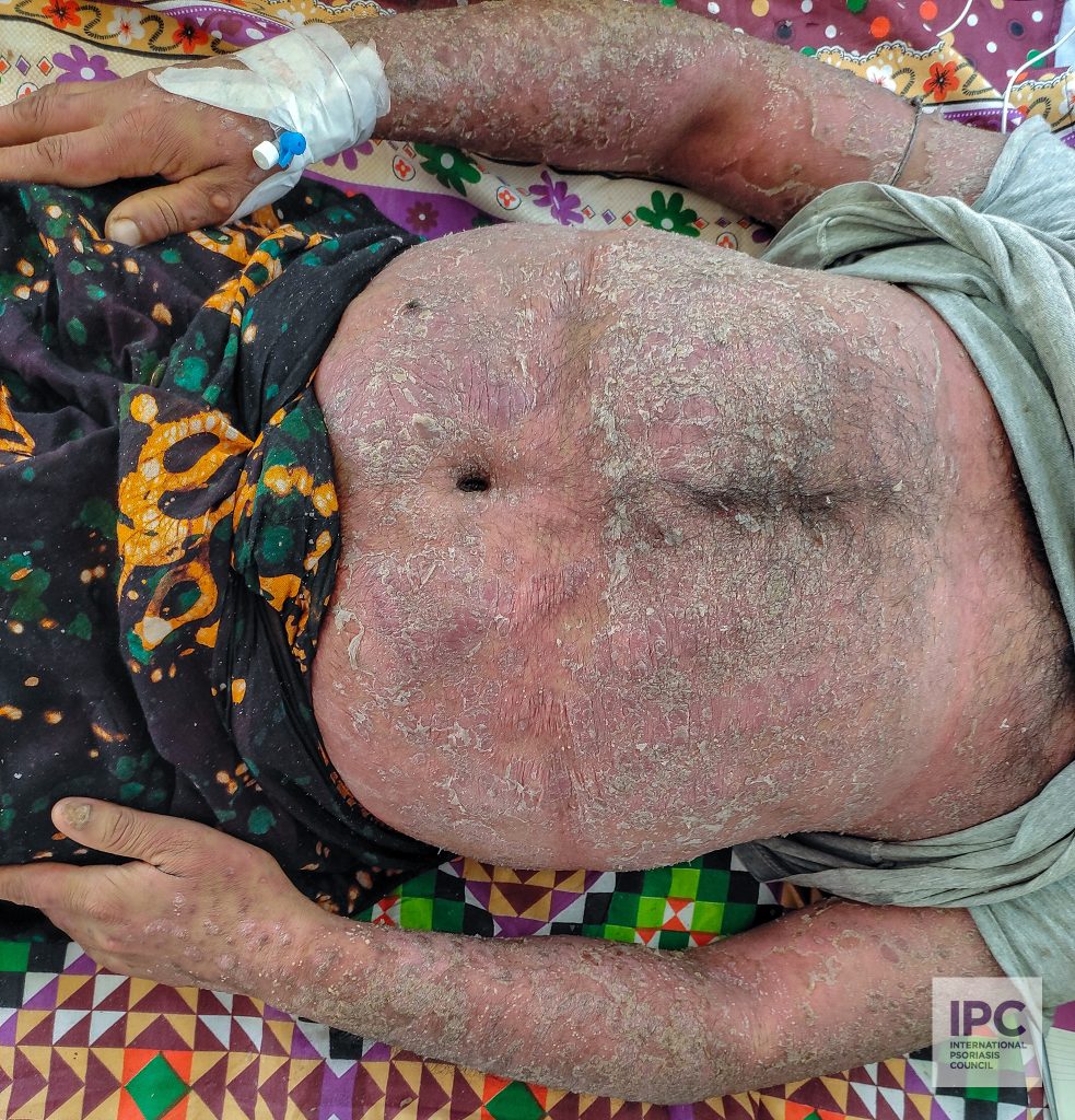 A male patient with pustular psoriasis presented with large scaly erythematous plaque with some pustules on the trunk and upper extremities