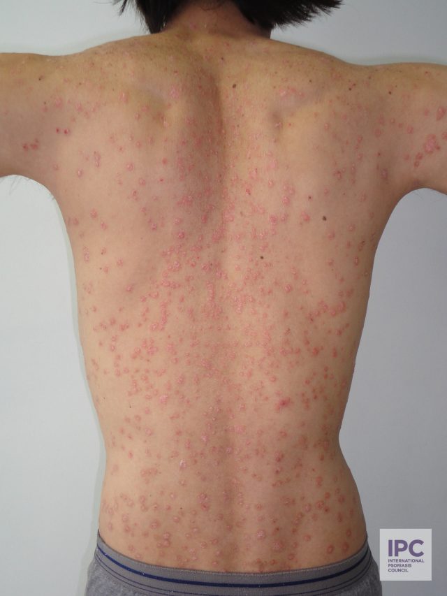 Guttate psoriasis