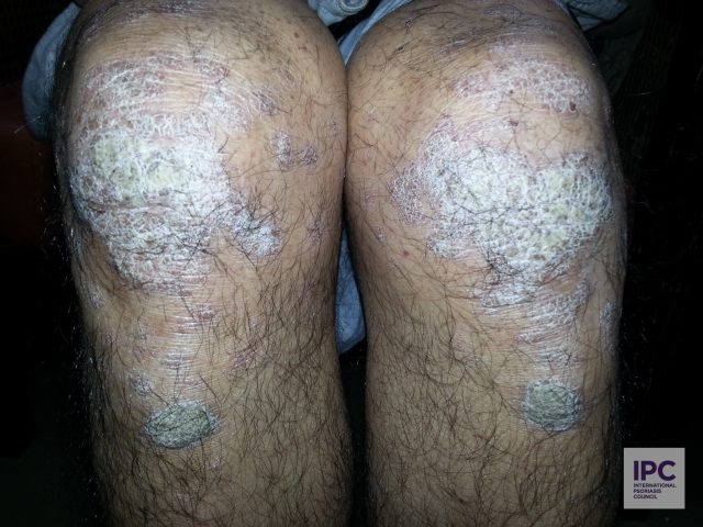 Plaque psoriasis