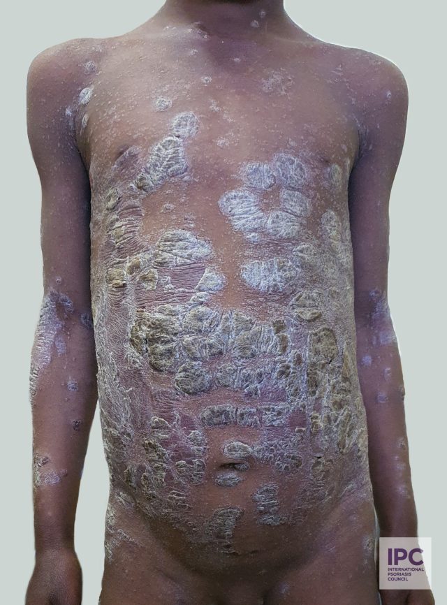10-year-old male patient with 2 month history of pruritic rash. Histopathologically confirmed: regular acanthosis, marked compact hyperkeratosis and parakeratosis, munro microabscess, dilated cappillaries in dermal papillae, and lymphohystiocytic perivascular dermal infiltrates seen. Rx: MTX 7.5 mg PO/week Urea 10% in simple cream vehicle daily. Was improving very well at first appointment.
