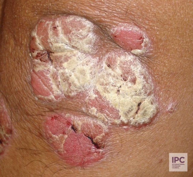 Plaque psoriasis