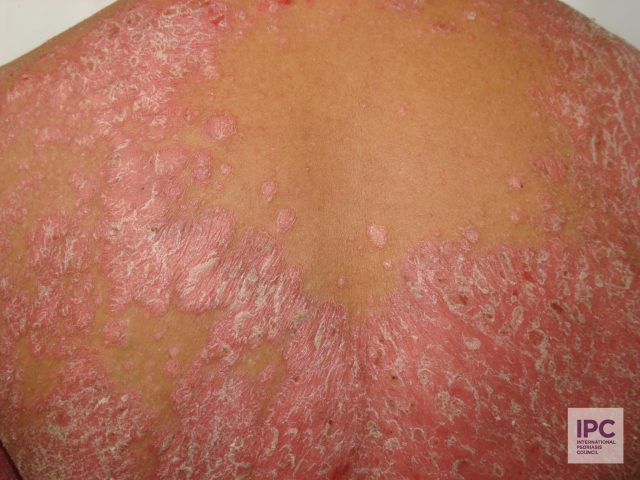 Plaque psoriasis