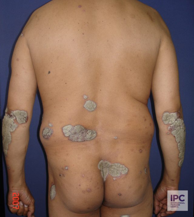 Plaque psoriasis
