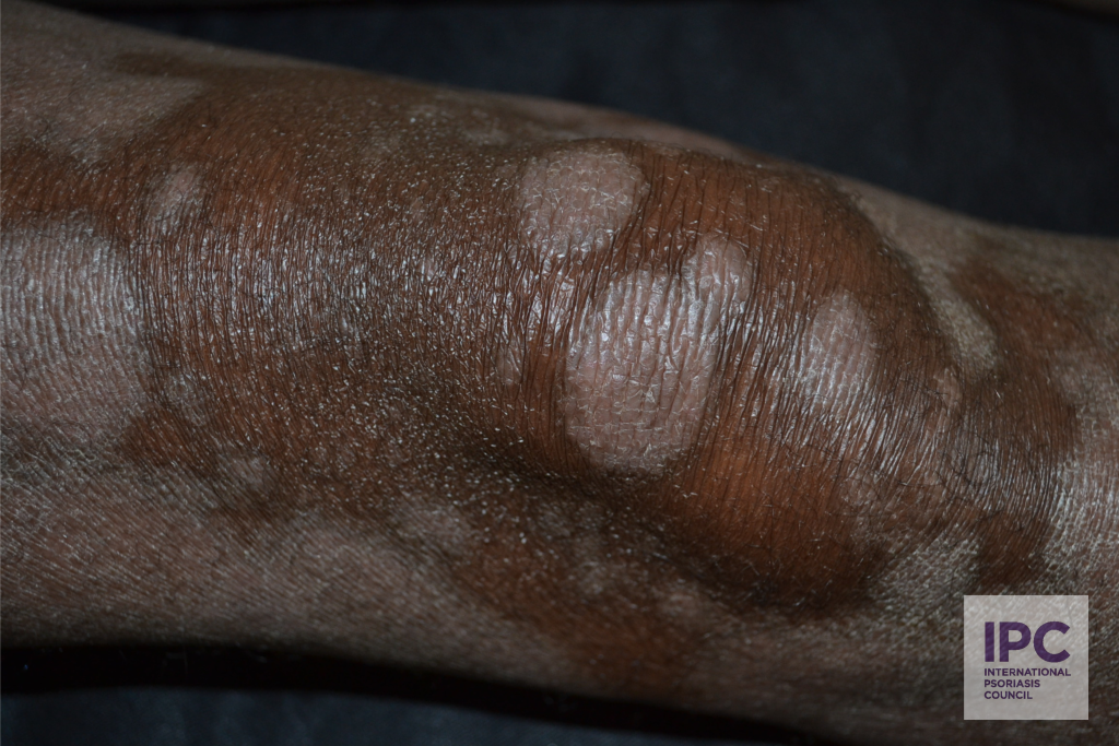 Plaque psoriasis