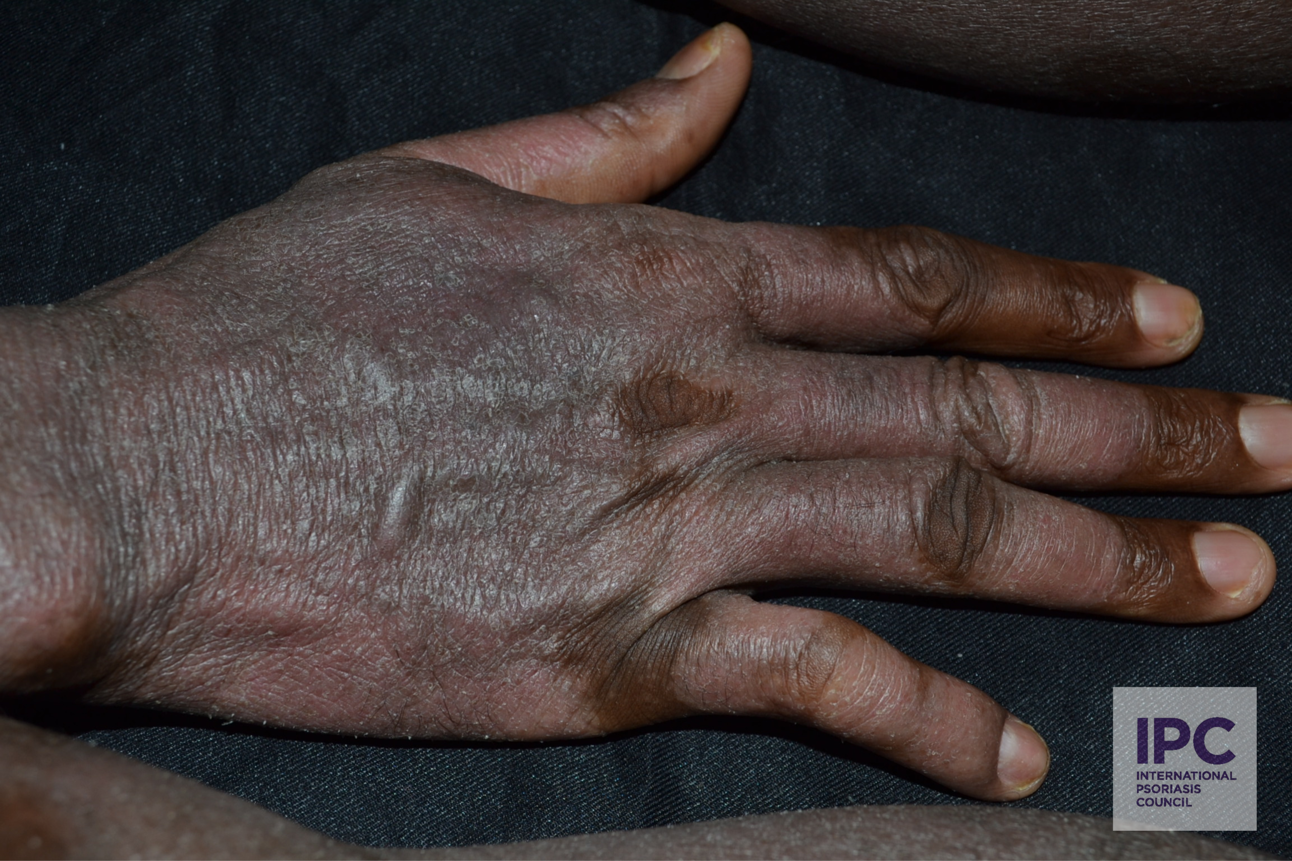 Plaque psoriasis