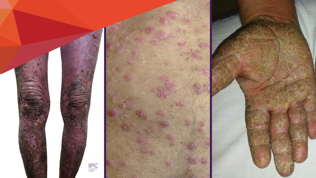 A collage shows: left, dark purple, scaly plaques on legs; center, pinkish raised spots on a torso; right, a hand with thick, scaly, yellowish skin and cracks—likely illustrating dermatological conditions for psoriasis patient resources.